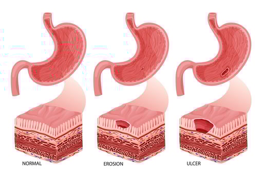 Stomach erosion and ulcer development illustration vector