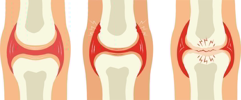 Knee joint pain. Vector illustration isolated on a white background.