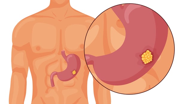 Stomach cancer. Malignant cancerous tumor. Anatomical vector illustration isolated white background cartoon style