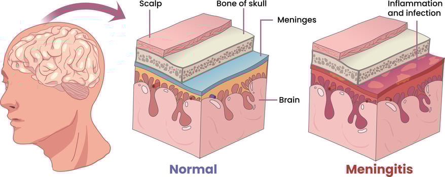 illustration of meningitis, inflammation membranes covering the brain vector