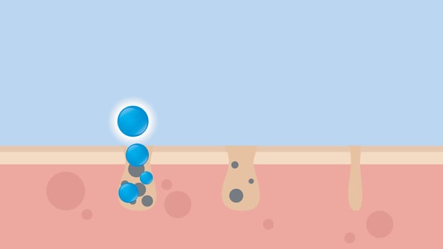 Acne Pimple treatment inflammation associated with pimples. On a blue background. The structure of the skin acne scar. Medical beauty skin care concept vector