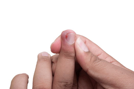 selective focus on bruised middle fingernails due to ingrown nails. in Indonesian it is called cantengan. paronychia disease. png