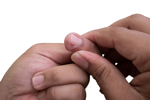 selective focus on bruised middle fingernails due to ingrown nails. in Indonesian it is called cantengan. paronychia disease. png