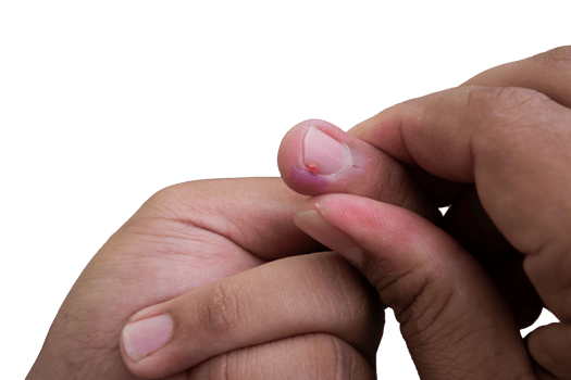 selective focus on bruised middle fingernails due to ingrown nails. in Indonesian it is called cantengan. paronychia disease. png