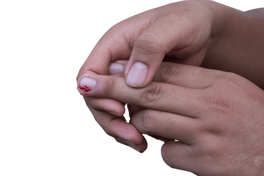 selective focus on bleeding fingers due to ingrown nails. in Indonesian it is called cantengan. paronychia disease. png