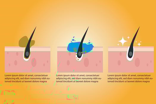Cleaning blackheads process flat illustration. Clogged pores removal, skin cleaning foam, skincare vector illustration