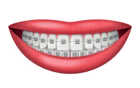 Teeth Braces Realistic vector