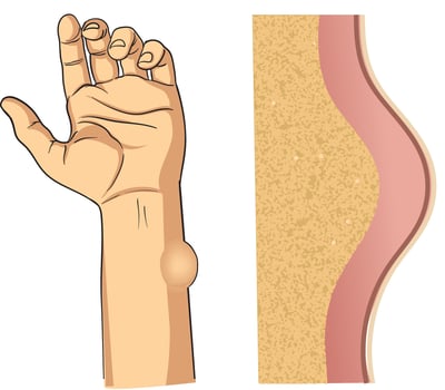 lipoma illustration in hand vector