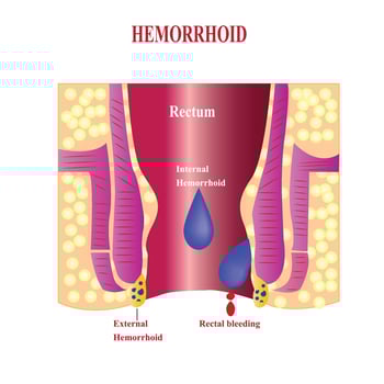 Internal hemorrhoids and external hemorrhoids. Hemorrhoids and inflammation cause bleeding through the fistula of the patient.Cross section of the rectum and anal canal vector