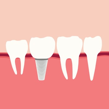 Surgery molar with tooth implant replacement in gum. For good dental healthy teeth. Screw denture orthodontic implantation. Stomatology clinic and dental implant concept. Realistic 3D vector. vector
