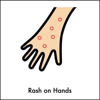 monkeypox virus symptoms pandemic Infographic and Effects Symptom icon png