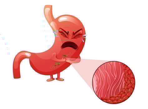 Crying cartoon stomach character with helicobacter pylori infection in epithelial cells under magnification vector