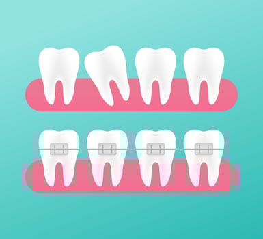 Correction of teeth with orthodontic braces. Stages of teeth alignment. Dental clinic services. Vector illustration