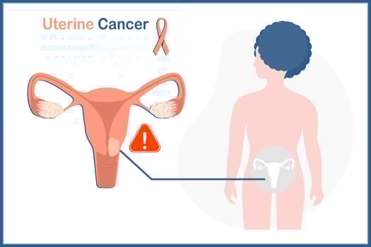 medical vector illustration concept In uterine cancer concept. Vector illustration of uterus and woman on white background.