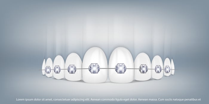 3d vector illustration, realistic teeth with braces upper and lower jaw. Alignment of the bite of teeth, dentition with braces, dental braces.