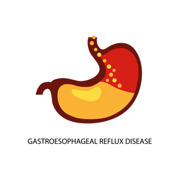 Gastroesophageal reflux disease. Stomach GERD heartburn esophagus medical illustration. png
