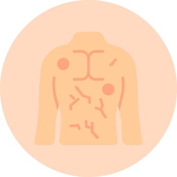 Hives Vector Icon
