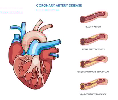 In Coronary artery disease heart arteries become narrow which reduced blood flow vector