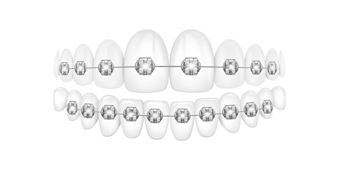 3d vector illustration, realistic teeth with braces. Alignment of the bite of teeth, dentition with braces, dental braces.