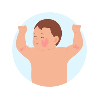 Pediatric Eczema or Atopic Dermatitis in infants and children.  Allergic itching, skin inflammation, redness and irritation. Dermatological problems in children. Vector illustration