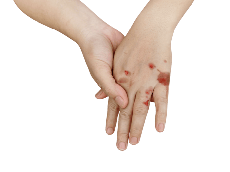 Hands with blisters from heat PNG transparent