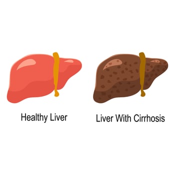 Comparison of healthy liver and liver cirrhosis disease. Medical infographic banner vector