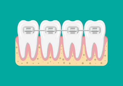 Teeth braces. Orthodontics and dentistry. Human tooth in flat style. Dental concept. Hygiene and oralcare. Vector illustration