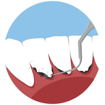 Professional teeth cleaning vector illustration. Book an appointment for teeth cleaning