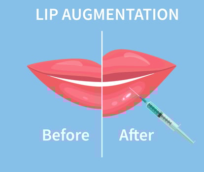 Lip Augmentation. Before and after lip filler injections. Hyaluronic Acid injections. Vector illustration in flat style