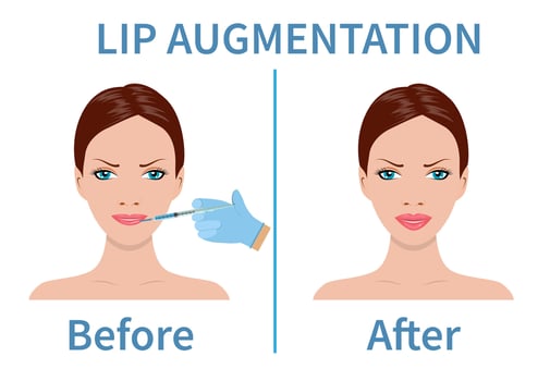 Lip Augmentation. Before and after lip filler injections. Hyaluronic Acid injections. Vector illustration in flat style