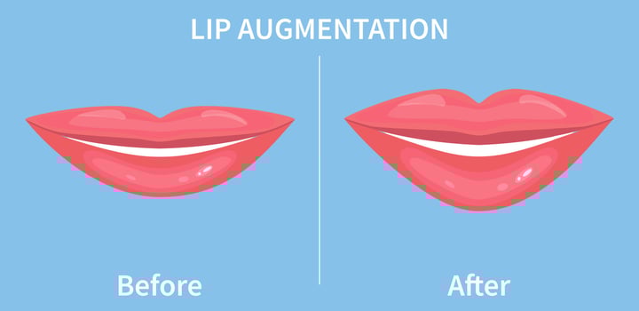 Lip Augmentation. Before and after lip filler injections. Hyaluronic Acid injections. Vector illustration in flat style