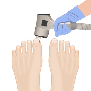 illustration of healthy feet, feet with ingrown toenails, treatment of ingrown toe and toe vector