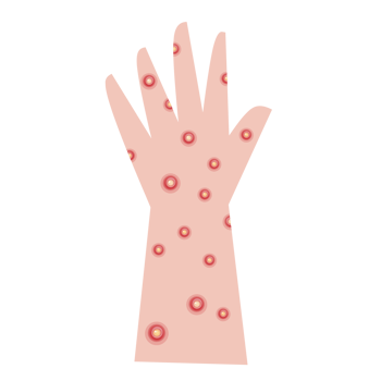 Hand with monkeypox png