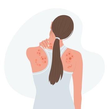 Allergic itching, skin inflammation, redness and irritation. Atopic dermatitis, eczema, psoriasis. Healthcare and medicine. Vector