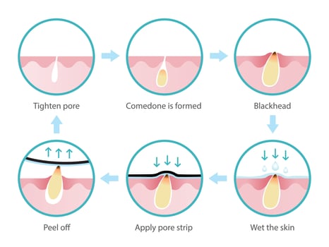 Life cycle of blackhead removal vector isolated on white background. Cross section of diagram blackhead pore skin, comedone is formed, expand to non inflammatory acne, treatment with pore strip.