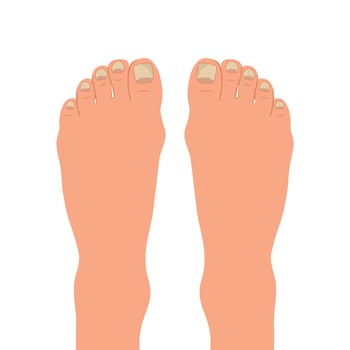 Swollen toe, onychocryptosis. Foot with nail disease or infection. Foot with onychomycosis or nail fungus. Healthcare and medicine. Vector