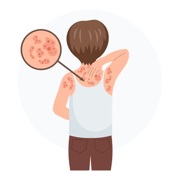 Allergic itching, skin inflammation, redness and irritation. A child with allergies. Healthcare and medicine. Vector