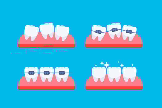 Teeth, orthodontic treatment. Braces on the teeth. Dental care health. Vector illustration