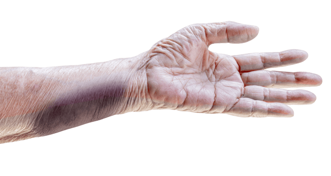 Arm of elderly woman has bruises png