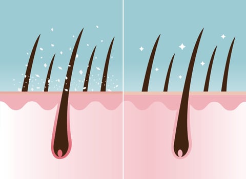 Comparison of dandruff in hair and healthy hair on scalp layer vector illustration. Hair with white dry flaky, scaly scalp and nourished. Hair care and problem concept.