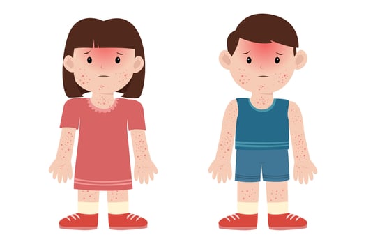 maculopapular rash, dengue fever disease symptom. mosquito control concept vector