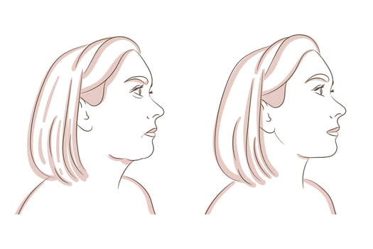 Reduce double chin, jawline plastic and cosmetology. Get rid of face and neck fat before and after concept. vector