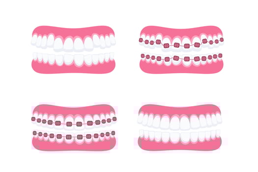 Teeth with braces. Orthodontic treatment. Tooth braces. Teeth with metal brackets vector