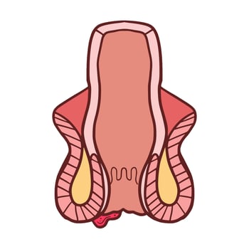 external hemorrhoids illustration vector