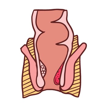 internal hemorrhoids stage 2 illustration vector