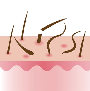 Hair fall with scalp layer illustration isolated on white background. Hair dry and brittle become weak and prone to breakage, shedding, alopecia and hair loss. Hair care and problem concept. vector