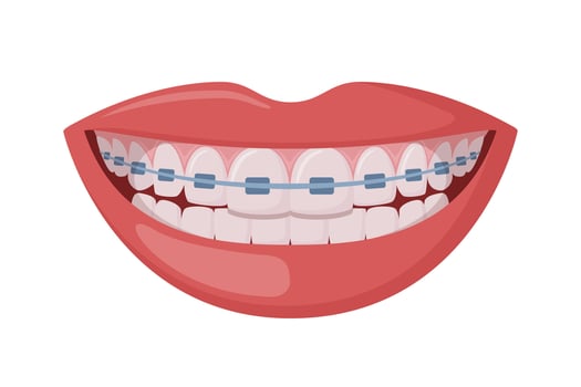 Braces Corrective Orthodontics, smiling female mouth with healthy teeth and braces. Dentistry, dental treatment, orthodontics. . vector