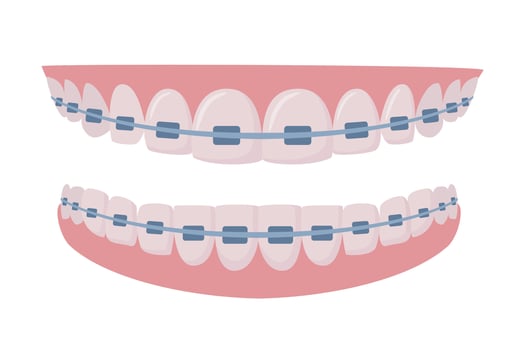 Upper and lower jaws with braces on teeth. Orthodontics and aesthetic dentistry medicine. Healthy smile. Dentistry, whitening, orthodontics. . vector