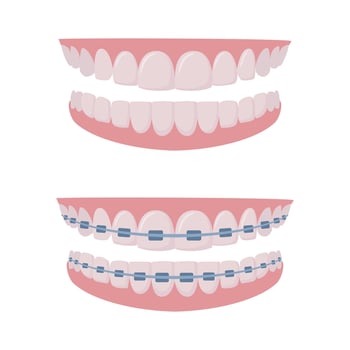 Upper and lower jaws with braces on teeth. Orthodontics and aesthetic dentistry medicine. Healthy smile. Dentistry, whitening, orthodontics. . vector