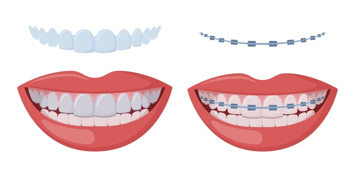 Braces Corrective Orthodontics, smiling female mouth with healthy teeth and braces. Teeth with transparent braces. Alignment of teeth by aligners. Invisible braces aligner, retainer. . vector